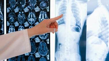 Cáncer de pulmón, el tumor maligno con mayor incidencia.
